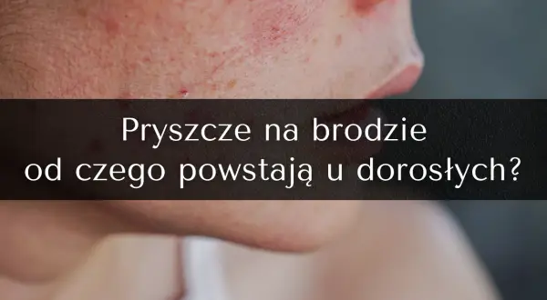 Od czego pryszcze na twarzy? Odkryj prawdziwe przyczyny i porady