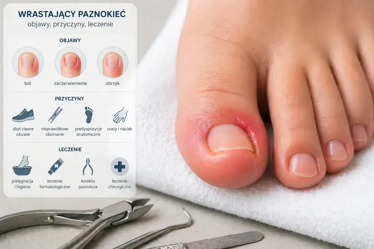 Wrastający paznokieć: objawy, przyczyny i leczenie. Jak wyciąć wrastający paznokieć? Informacje o bólu, zaczerwienieniu, obrzęku, przyczynach i metodach leczenia.